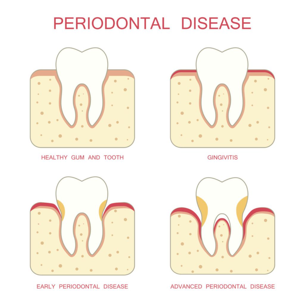 Stages of periodontal disease treatment in Westborough MA