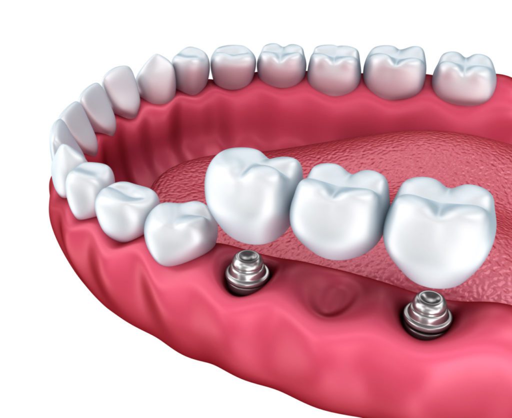 Affordable implant-supported dental bridge in Westborough Massachusetts