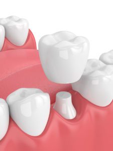 Affordable dental crowns in Westborough Massachusetts