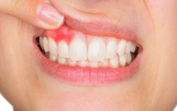 treating bleeding gums and gingivitis in Westborough MA