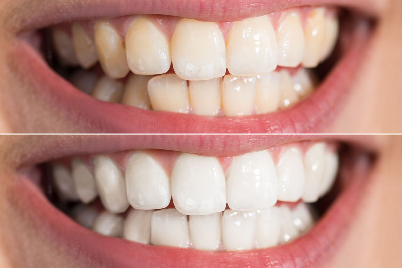Treating Discolored Teeth | Westborough, MA Dentist