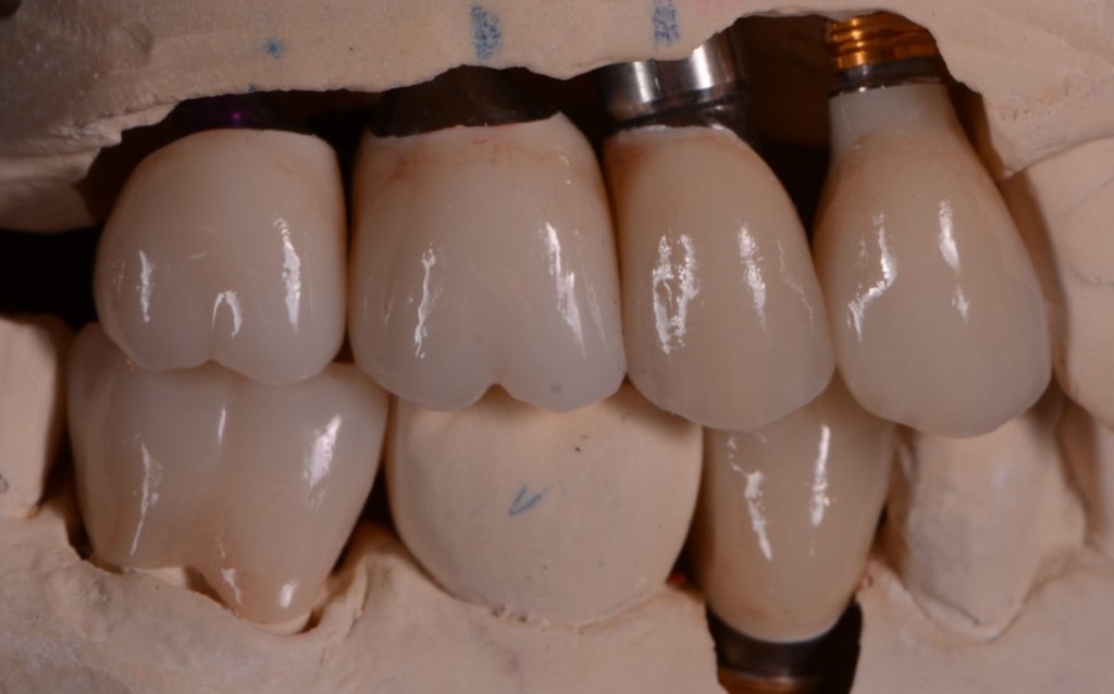 missing teeth in Westborough, MA