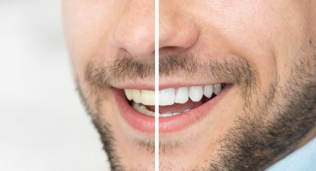Dental care and whitening teeth. Compare smile before and after bleaching. Cosmetic dentistry dentist in Westborough Massachusetts 